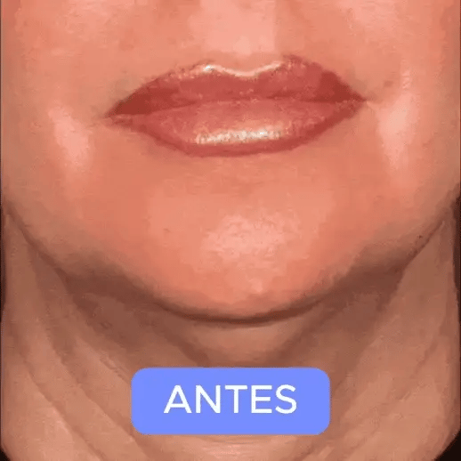 Botox Stock Solution Suero antiarrugas